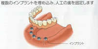 すべての歯を失った場合：インプラント治療
