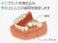 隣接する歯を1、2本失った場合：インプラント治療