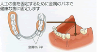 奥歯を含めて複数の歯を失った場合：ブリッジ・部分入れ歯・総入れ歯