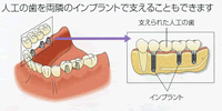 奥歯を含めて複数の歯を失った場合：インプラント治療
